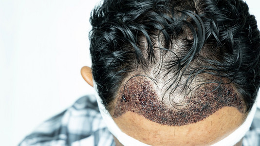 健康头部做发移植手术的人有后发线FUUE软体细胞抽取理发手术类型及其各阶段的头发移植手术者种园乐器图片