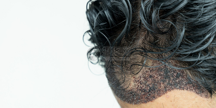 脱发乐器头部做移植手术的人有后发线FUUE软体细胞抽取理发手术类型及其各阶段的头发移植手术者后退图片
