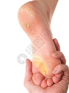 皮肤学家检查一脚的骨和干皮肤向白人们疣温泉图片
