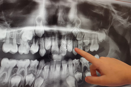乳制品和新生儿童牙齿的X射线照片健康背部纸图片