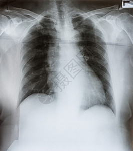 慢阻塞肺病女健康XRay人类男胸罩图像背景图片