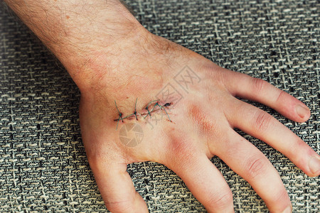 手上暗缝线伤口事故概念的疼痛事故概念的疼痛医生条白色的图片