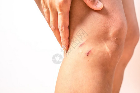 磨损女膝盖上两处刮伤有大疤痕缝合保健和医疗概念血液违反图片