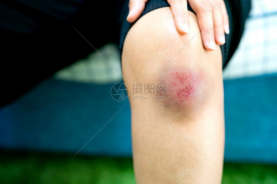 膝盖受伤的男性特写图片
