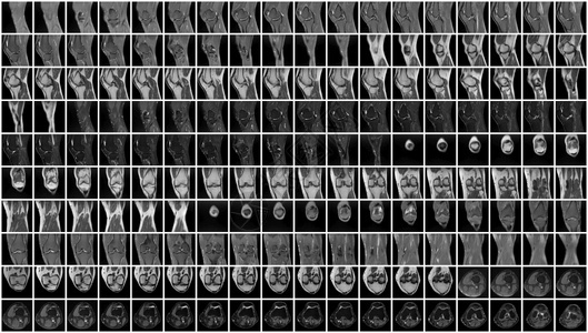左膝的磁共振成像MRI生病的放射学线照相图片