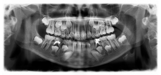 牙疼牛奶光谱射电仪是一种扫描牙科X光片对上下巴进行检查降低图片