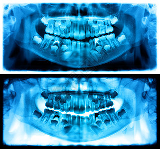 智慧全景X光片是上颌骨和下的扫描牙科光片照显示一个7岁的孩子儿童全景牙科光片龋齿基本的图片