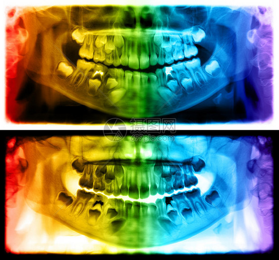 伦琴光谱射电仪是一种扫描牙科X射线对上下巴进行检查落叶孩子图片