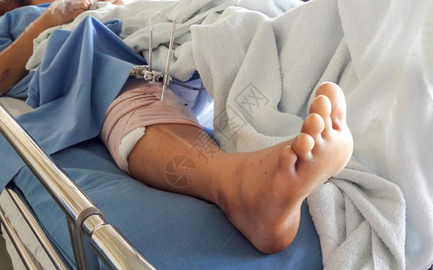 腿部受伤治疗的病人图片
