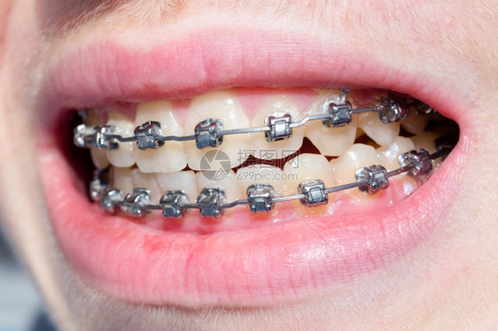 关心牙医括号长着齿和嘴唇的十几岁男孩嘴唇图片