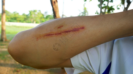 户外自然假期男人手臂周围的皮肤有伤痕图片素材