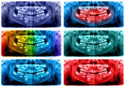 脸颚骨全景X光片是上颌骨和下的扫描牙科光片照显示一个7岁的孩子彩色图像全景牙科光片洞图片