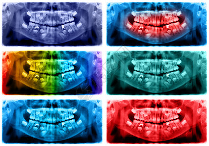 脸颚骨全景X光片是上颌骨和下的扫描牙科光片照显示一个7岁的孩子彩色图像全景牙科光片洞图片