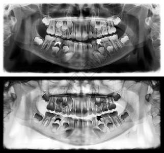 下颌骨孩子光谱射电仪是一种扫描牙科X光片对上下巴进行检查牛奶图片