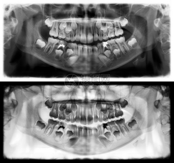 下颌骨孩子光谱射电仪是一种扫描牙科X光片对上下巴进行检查牛奶图片