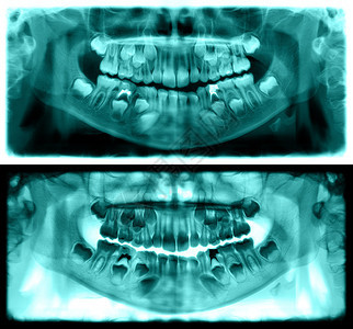 牛奶龋齿光谱射线仪是一种扫描牙科X光片对上下巴进行检查该照片显示一名7岁儿童的年龄为7岁红图象全景牙医X光片X射线图片