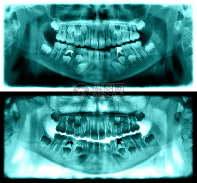牛奶龋齿光谱射线仪是一种扫描牙科X光片对上下巴进行检查该照片显示一名7岁儿童的年龄为7岁红图象全景牙医X光片X射线图片