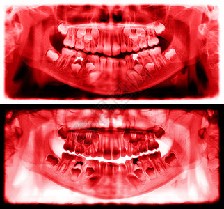 光谱射线仪是一种扫描牙科X光片对上下巴进行检查该照片显示一名7岁儿童的年龄为7岁红图象全景牙医X光片降低红色的运河图片