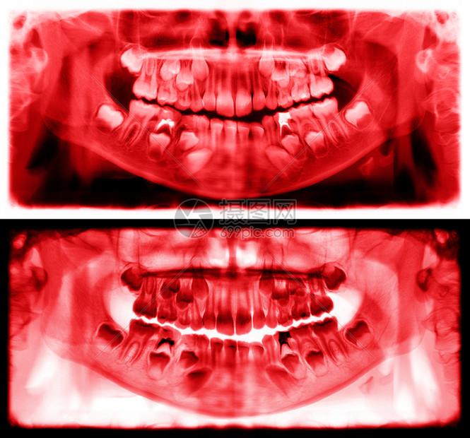光谱射线仪是一种扫描牙科X光片对上下巴进行检查该照片显示一名7岁儿童的年龄为7岁红图象全景牙医X光片降低红色的运河图片