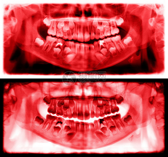 光谱射线仪是一种扫描牙科X光片对上下巴进行检查该照片显示一名7岁儿童的年龄为7岁红图象全景牙医X光片降低红色的运河图片