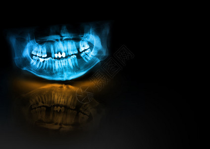 重建全景线照片是上颌骨和下黑色背景的扫描牙科X射线具有发光阴影和反射的医学水平设计文本模板辉光图片