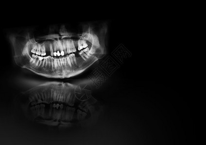 全景射线照片是上颌骨和下黑色背景的扫描牙科X射线具有发光阴影和反射的医学水平设计文本模板消极的重建人类图片