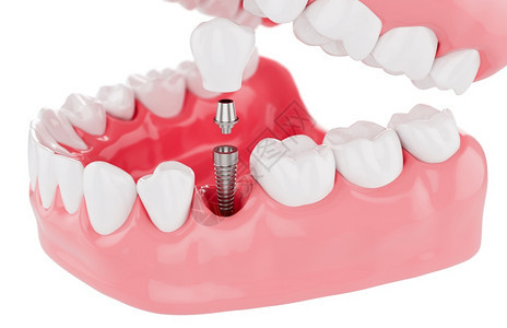 胶白底植树牙齿保健选择焦点3D立体切除器植入物使固定图片