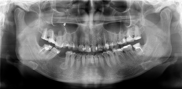降低下颌骨光谱射电仪是上下巴的全景扫描牙科X光片这是一部中央平面断层摄影机描绘了一名30岁妇女最大和美的体形放射学图片