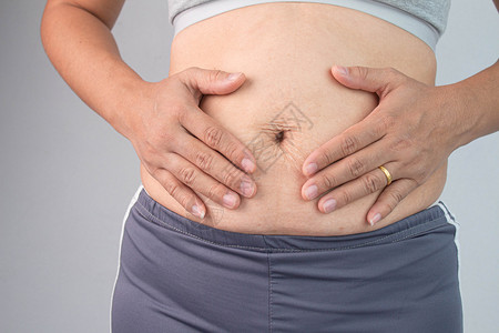 胖的产后妇女近距离接触腹部皮肤在分娩后拉伸伤痕和松皮对肤身体形状的保健概念丑陋图片