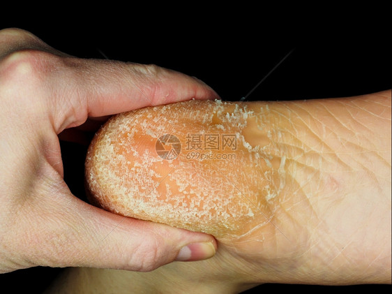 由足科医生检查的成年人脚跟皮剥离肤朝黑方向划去感染经过裂缝图片