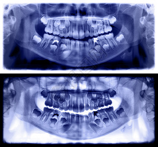 颅骨放射学降低全景X光片是上颌骨和下的扫描牙科光片照显示一个7岁儿童紫罗兰色全景牙科图片