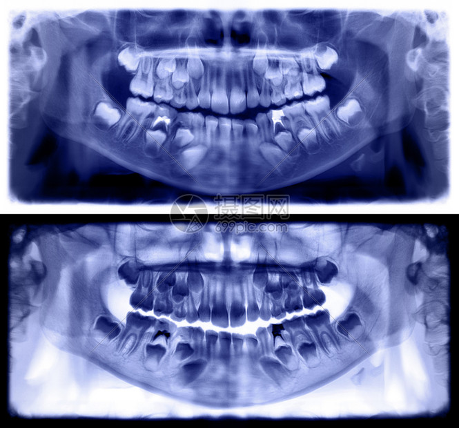 颅骨放射学降低全景X光片是上颌骨和下的扫描牙科光片照显示一个7岁儿童紫罗兰色全景牙科图片
