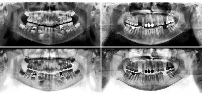 微笑降低照片显示一名三十七岁的年轻男子龄在三十七个37岁流行牙科X射线根的图象这幅是一全天牙X射线齿孔图象伦琴图片