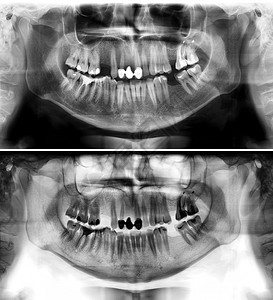 照片显示一名三十七岁的青年男子一个37岁的青年男子全景牙医X光片这张照显示一名年龄在三十七岁的年轻人一个3至7岁的青年男子龋齿轻图片