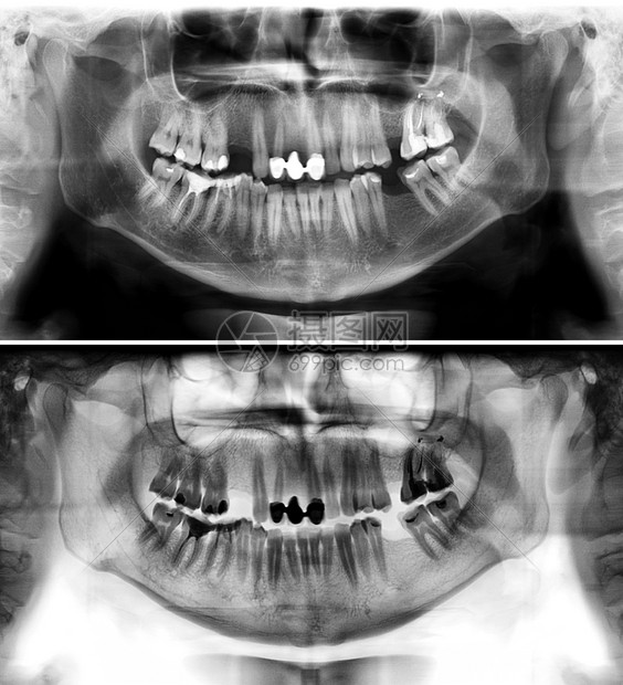 照片显示一名三十七岁的青年男子一个37岁的青年男子全景牙医X光片这张照显示一名年龄在三十七岁的年轻人一个3至7岁的青年男子龋齿轻图片