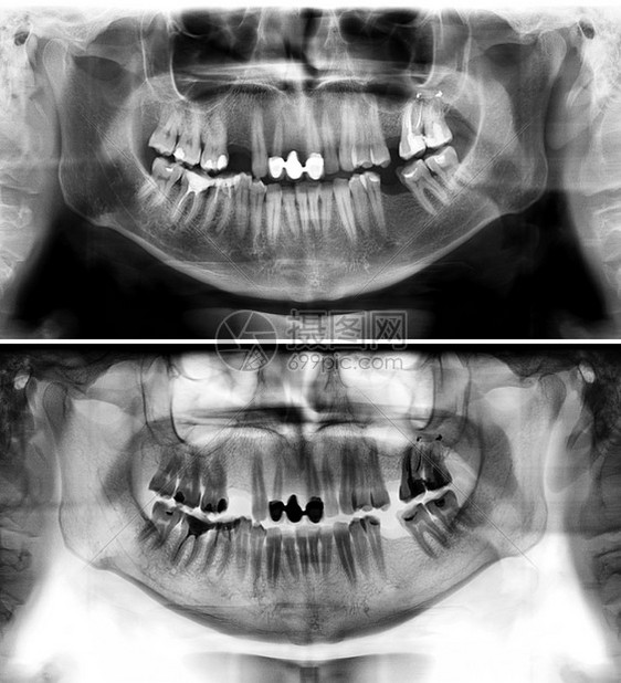照片显示一名三十七岁的青年男子一个37岁的青年男子全景牙医X光片这张照显示一名年龄在三十七岁的年轻人一个3至7岁的青年男子龋齿轻图片