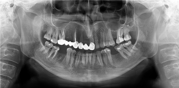 颅骨泛光射电图是全景扫描的牙科X线上下两端这是一架焦平面断层摄影仪显示一个40岁的男子最大和可变体民主共国下颌骨图片