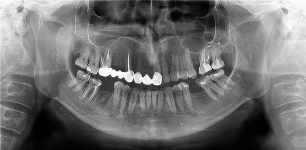 颅骨泛光射电图是全景扫描的牙科X线上下两端这是一架焦平面断层摄影仪显示一个40岁的男子最大和可变体民主共国下颌骨背景图片