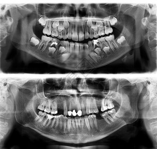 基本的上颌骨光谱射线仪PanoramiccentryXray是一对30岁7的年轻人牙齿X射线根小牛图片