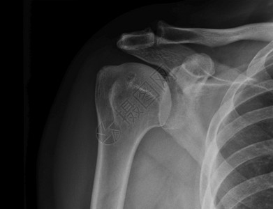 扫描X射线XX肩式电图显示受伤状况科学图片
