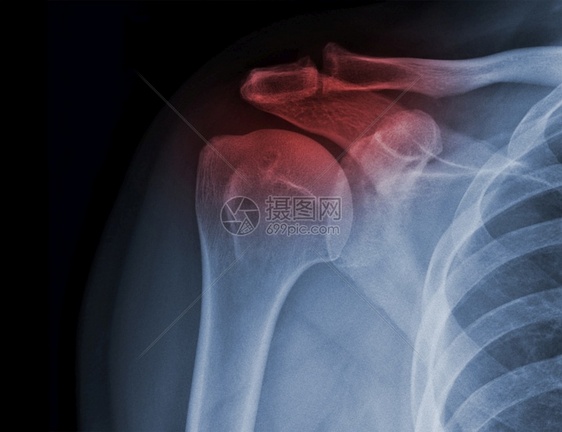 肌肉骨骼X射X线肩式电图显示受伤状况病人医疗的图片