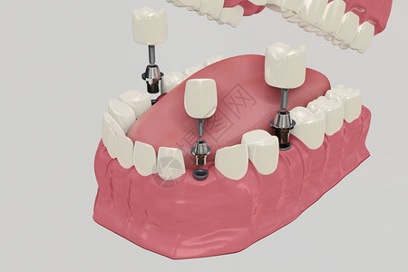 3D假牙种植图片