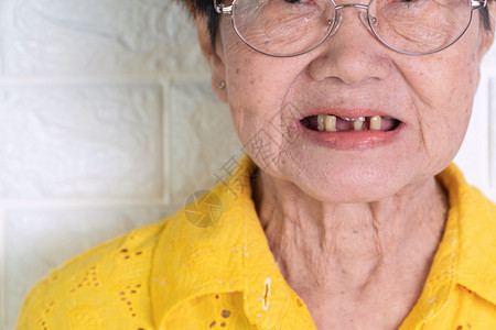 70岁以上的亚洲老年妇女笑着微牙齿有几颗断裂的牙齿这里难以咀嚼老人的食物这里需要假牙来替代缺失的齿和帮助咀嚼食物这需要用假牙替换图片