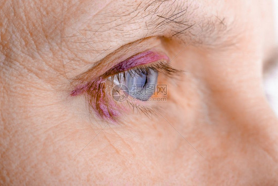 危险铁青伤口由于毛细管破裂造成血肿或瘀伤而受的妇女眼部也可能是结膜炎或其他过敏眼睛炎艾滋图片