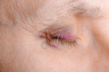 静脉药物导致由于毛细管破裂造成血肿或瘀伤而受的妇女眼部也可能是结膜炎或其他过敏眼睛炎艾滋图片