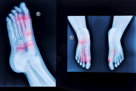 跟谁学手术临床正常的足放射医疗诊断创伤学和矫形外科等X射线脚跟背景