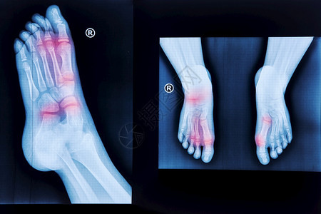 手术临床正常的足放射医疗诊断创伤学和矫形外科等X射线脚跟图片