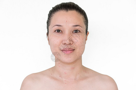 医疗的亚洲妇女脸部和颈的烧焦点或激光处理蜡烛皮肤雀斑和黑在燃烧激光处理后头发皮肤科医生图片