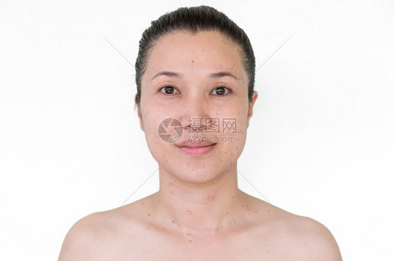 医疗的亚洲妇女脸部和颈的烧焦点或激光处理蜡烛皮肤雀斑和黑在燃烧激光处理后头发皮肤科医生图片