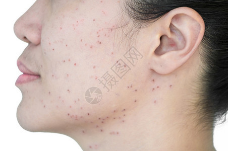 脸收紧亚洲妇女激光治疗的面部和颈激光处理器皮肤雀斑和黑暗点产生的烧或沙巴者图片